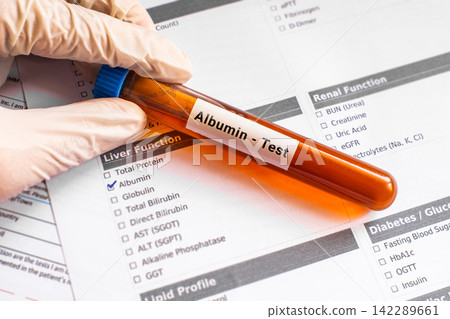 blood sample in lab tube for Albumin test 142289661