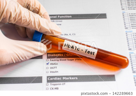 blood sample in lab tube for HbA1c test blood sample in lab tube for HbA1c test 142289663