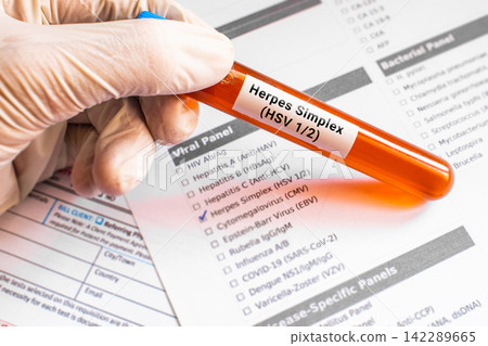 blood sample in lab tube for Herpes Simplex test blood sample in lab tube for Herpes Simplex test 142289665