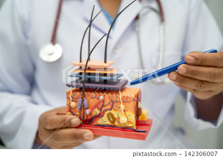 Hair transplant, Asian dermatologist doctor holding skin structure anatomy model for treatment in hospital. 142306007