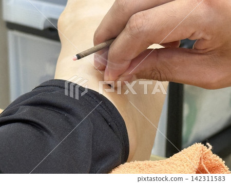 Acupuncture Acupuncture 142311583