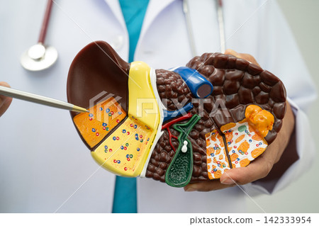 Cirrhosis, Liver cancer, fatty liver, Asian doctor with liver human model. 142333954