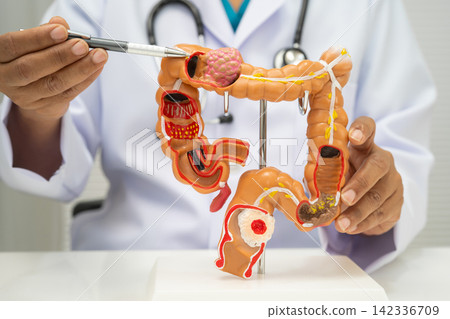 Colorectal cancer, doctor holding intestine colon human anatomy model. 142336709