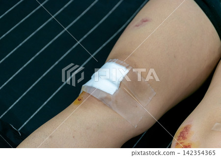 Close view of an injured knee covered gauze medical tape showing bruises minor wounds the leg during recovery after an accident Close view of an injured knee covered gauze medical tape showing bruises minor wounds the leg during recovery after an accident 142354365