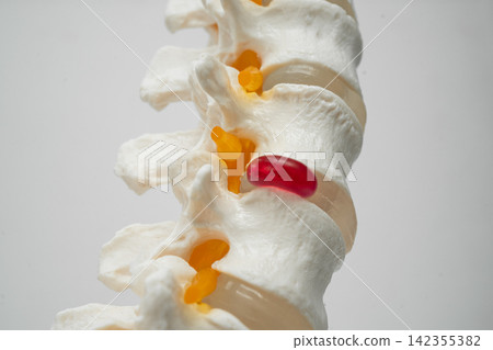 Lumbar spine displaced herniated disc fragment, spinal nerve and bone. Model for treatment medical in the orthopedic department. Lumbar spine displaced herniated disc fragment, spinal nerve and bone. Model for treatment medical in the orthopedic department. 142355382