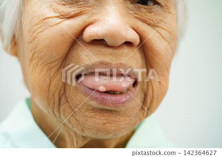 Cysts at the tongue in mouth of Asian elderly old lady woman patient. Cysts at the tongue in mouth of Asian elderly old lady woman patient. 142364627