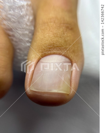 Podology closeup of toenail before pedicure, natural nail plate and dry cuticle, medical foot care macro Podology closeup of toenail before pedicure, natural nail plate and dry cuticle, medical foot care macro 142366742