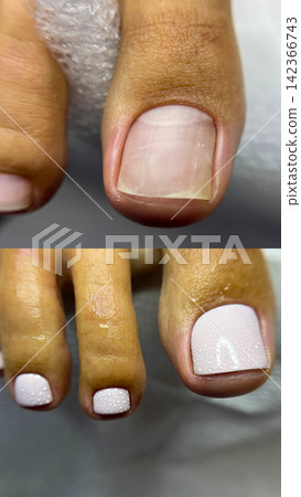 Podology pedicure before and after, toenail macro with natural nail and polished result, medical foot care comparison Podology pedicure before and after, toenail macro with natural nail and polished result, medical foot care comparison 142366743