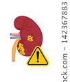 human kidney illustration showing kidney stones disease and warning sign 142367883