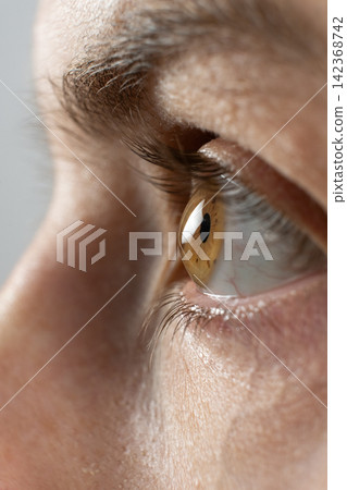 Conical cornea deformity in severe keratoconus patient Conical cornea deformity in severe keratoconus patient 142368742