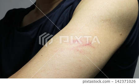 Close-up of a bruise on the arm Close-up of a bruise on the arm 142371026
