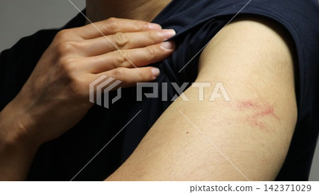 Close-up of a person with an injured arm Close-up of a person with an injured arm 142371029