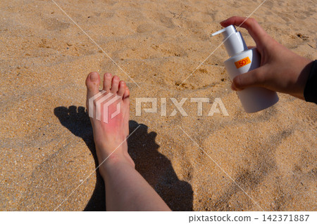 Sunburn on a girl's leg on the beach, skincare for summer holiday in South Korea Sunburn on a girl's leg on the beach, skincare for summer holiday in South Korea 142371887