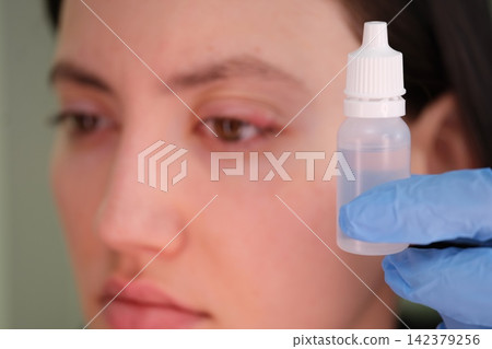 Antibacterial or antiviral eye drops on woman inflamed chalazion closeup Antibacterial or antiviral eye drops on woman inflamed chalazion closeup 142379256