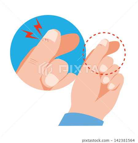 Hangnail on the thumb Hangnail on the thumb 142381564
