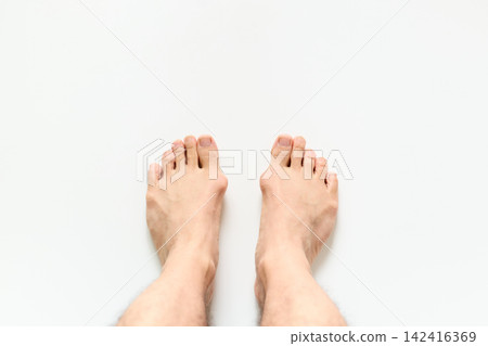 A man's foot with bunions A man's foot with bunions 142416369