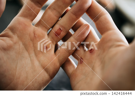 Close-up of climber examining torn skin and calluses on both palms after bouldering, visible climbing-related hand injuries, chalk-free hands, sports recovery, hand care and authentic athlete Close-up of climber examining torn skin and calluses on both palms after bouldering, visible climbing-related hand injuries, chalk-free hands, sports recovery, hand care and authentic athlete 142416444
