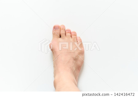 患有拇趾外翻的男子的右腳 患有拇趾外翻的男子的右腳 142416472