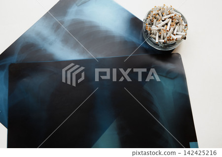 Chest X-rays lie on a white table next to an ashtray full of cigarette butts.  142425216