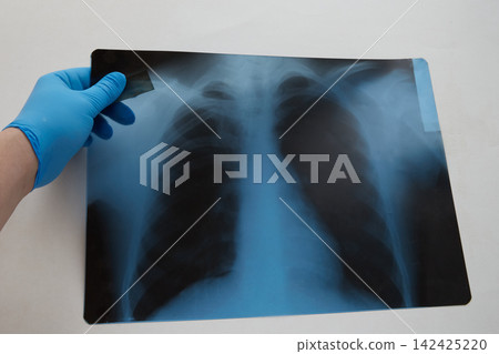 A hand in a blue medical glove holding a chest X-ray on a white background. A hand in a blue medical glove holding a chest X-ray on a white background. 142425220
