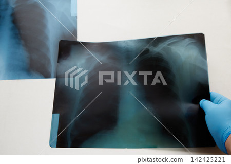A hand in a blue medical glove holding a chest X-ray on a white background, and another X-ray. A hand in a blue medical glove holding a chest X-ray on a white background, and another X-ray. 142425221