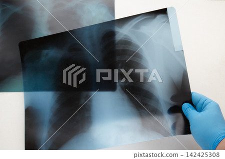 A hand in a blue medical glove holding one x-ray of lungs on the background of another. A hand in a blue medical glove holding one x-ray of lungs on the background of another. 142425308