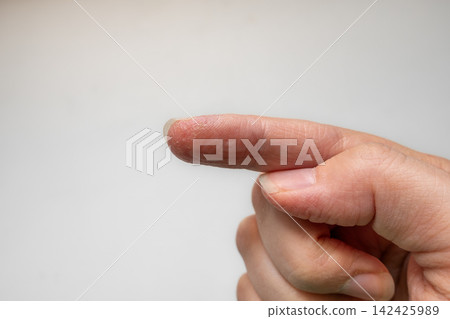 Close up of hand showing dry flaky skin affected by eczema dermatitis on white background Close up of hand showing dry flaky skin affected by eczema dermatitis on white background 142425989