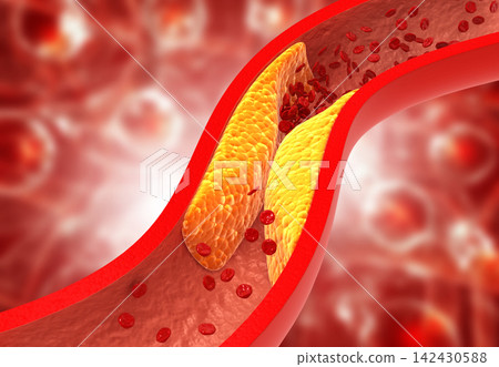 Clogged arteries, Cholesterol plaque in artery 142430588