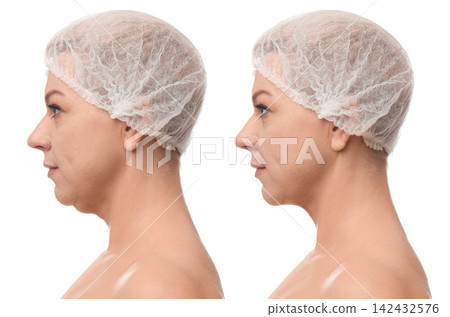 Mature woman before and after plastic surgery operation on white background. Double chin problem Mature woman before and after plastic surgery operation on white background. Double chin problem 142432576