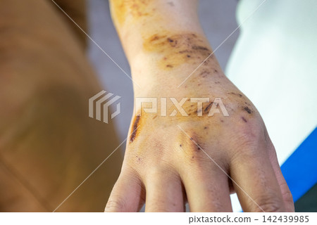 Close view of an injured hand wrist bruises abrasions scabs antiseptic stains showing healing skin after physical trauma Close view of an injured hand wrist bruises abrasions scabs antiseptic stains showing healing skin after physical trauma 142439985
