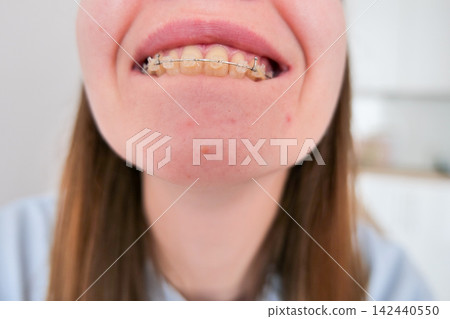 Person Showing Dental Braces on Teeth Person Showing Dental Braces on Teeth 142440550