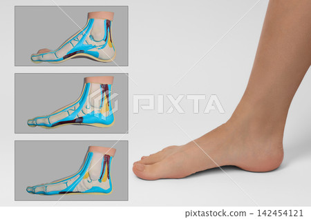 Bare female foot positioned alongside three anatomical cross-section models demonstrating normal high and flat plantar arches Bare female foot positioned alongside three anatomical cross-section models demonstrating normal high and flat plantar arches 142454121