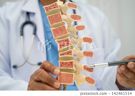 Doctor holding osteoporosis in back bone model for treatment medical in orthopedic department. Doctor holding osteoporosis in back bone model for treatment medical in orthopedic department. 142461514