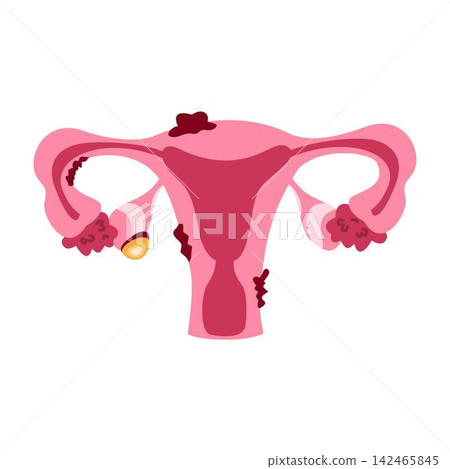 endometriosis organ infection ovary illustration endometriosis organ infection ovary illustration 142465845
