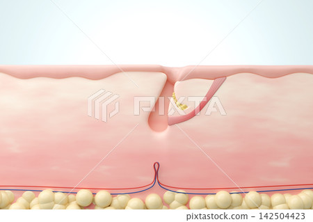 A 3DCG explanation of the hair cycle and the cross-sectional structure of hair thinning caused by hair papilla damage in AGA (Androgenetic Alopecia). A 3DCG explanation of the hair cycle and the cross-sectional structure of hair thinning caused by hair papilla damage in AGA (Androgenetic Alopecia). 142504423