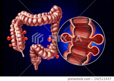 Diverticulosis Disease Diverticulosis Disease 142511437