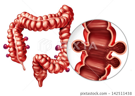 Diverticulosis With Colonic Diverticula Diverticulosis With Colonic Diverticula 142511438