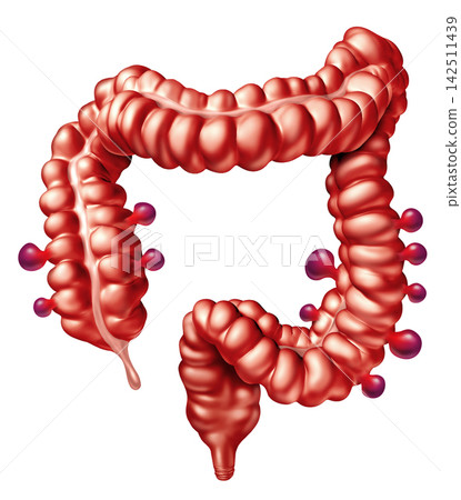 Symptomatic Diverticular Disease Symptomatic Diverticular Disease 142511439