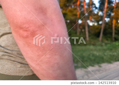 Closeup of swollen red insect bite on forearm skin, blurred forest background. Concept of allergic reaction, mosquito bite, tick warning, outdoor safety, skincare Closeup of swollen red insect bite on forearm skin, blurred forest background. Concept of allergic reaction, mosquito bite, tick warning, outdoor safety, skincare 142513910