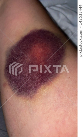 Large Purple Bruise on Human Leg Large Purple Bruise on Human Leg 142533444