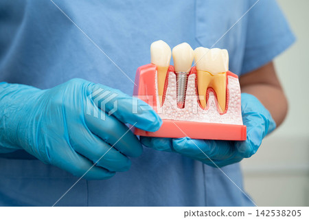 Dental implant, artificial tooth roots into jaw, root canal of dental treatment, gum disease, teeth model for dentist studying about dentistry. Dental implant, artificial tooth roots into jaw, root canal of dental treatment, gum disease, teeth model for dentist studying about dentistry. 142538205