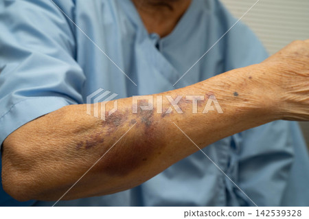 Ecchymosis, elderly bleeding on her arm after taking aspirin. Ecchymosis, elderly bleeding on her arm after taking aspirin. 142539328