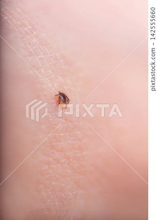 Little tick on human skin. Small Ixodes scapularis suck blood Little tick on human skin. Small Ixodes scapularis suck blood 142555660