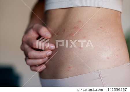 Woman scratching itchy red rash on side as skin irritation symptom Woman scratching itchy red rash on side as skin irritation symptom 142556267
