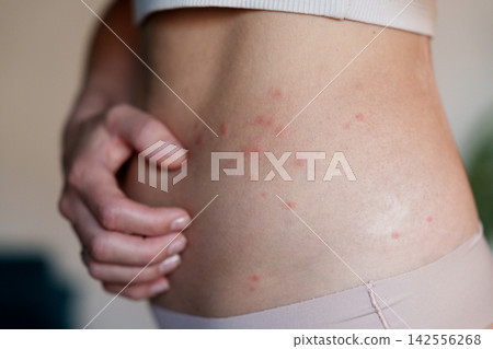 Woman scratching itchy red rash on side as skin irritation symptom Woman scratching itchy red rash on side as skin irritation symptom 142556268