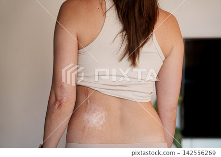Burn scars on woman back and elbow shown as skin healing detail Burn scars on woman back and elbow shown as skin healing detail 142556269