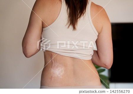 Burn scars on woman back and elbow shown as skin healing detail Burn scars on woman back and elbow shown as skin healing detail 142556270
