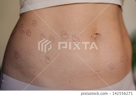Marked red skin spots on woman abdomen for home rash monitoring Marked red skin spots on woman abdomen for home rash monitoring 142556271