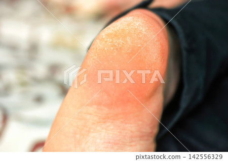 Hair splinter stucking in skin on rough dry mens heel close up Hair splinter stucking in skin on rough dry mens heel close up 142556329