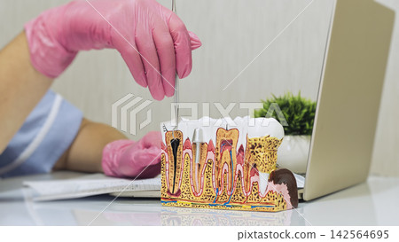Dentist in pink medical gloves using an explorer tool to point at a tooth decay cavity on an anatomical cross section model in a clinic. Dentist in pink medical gloves using an explorer tool to point at a tooth decay cavity on an anatomical cross section model in a clinic. 142564695